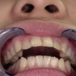 永野楓果チャンの歯・口内のどちんこ観察！！