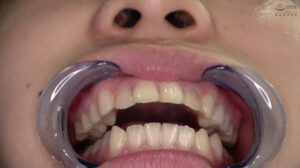 永野楓果チャンの歯・口内のどちんこ観察！！