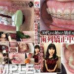 30代から始めた矯正を徹底鑑賞！歯列矯正中の熟女