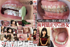 30代から始めた矯正を徹底鑑賞！歯列矯正中の熟女